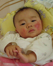 婴儿湿疹 湿疹最佳治疗方法 婴儿湿疹症状 湿疹 湿疹症状